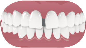Teeth spacing (Diastema)