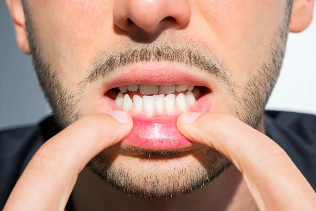 Teeth misalignment