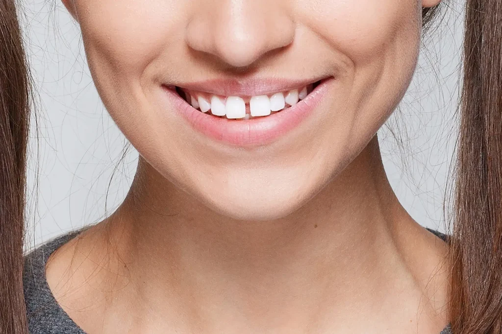 Diastema (Teeth spacing)