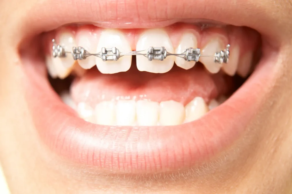 Traditional braces for diastema correction