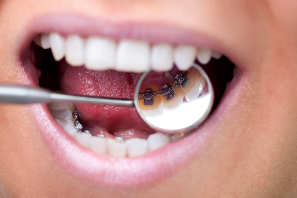 Innvendig tannregulering
