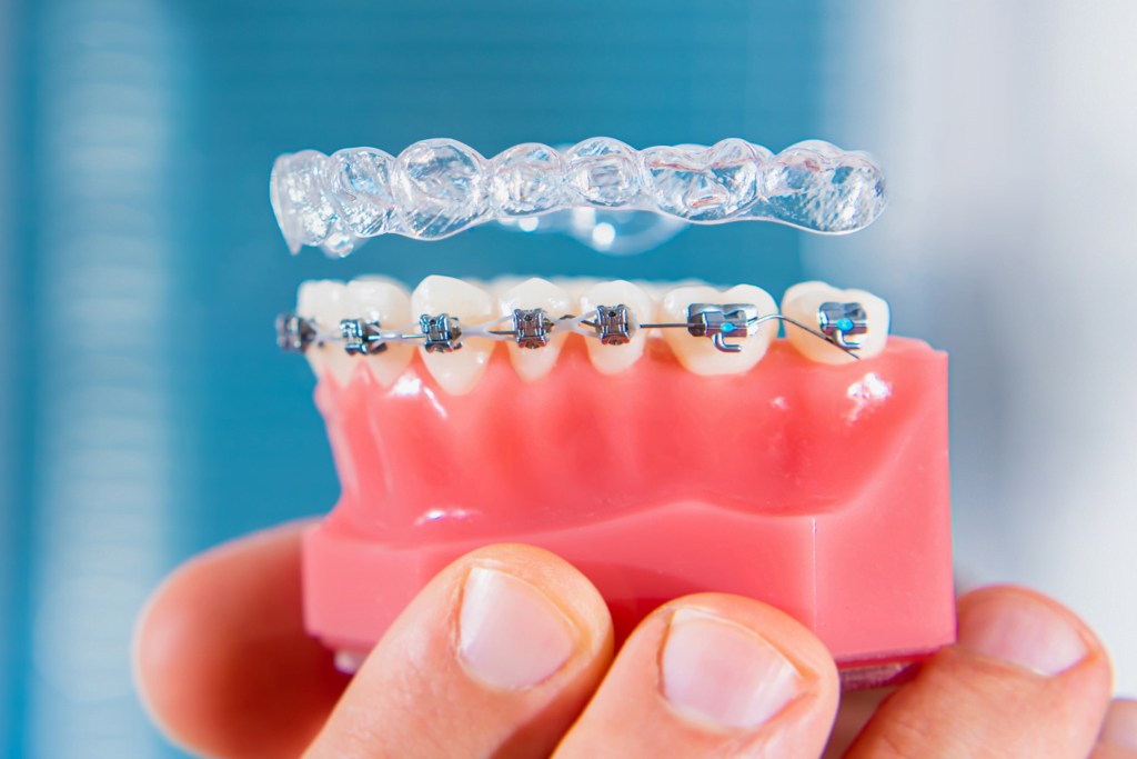  gjennomsiktig tannregulering vs. tradisjonelle reguleringer